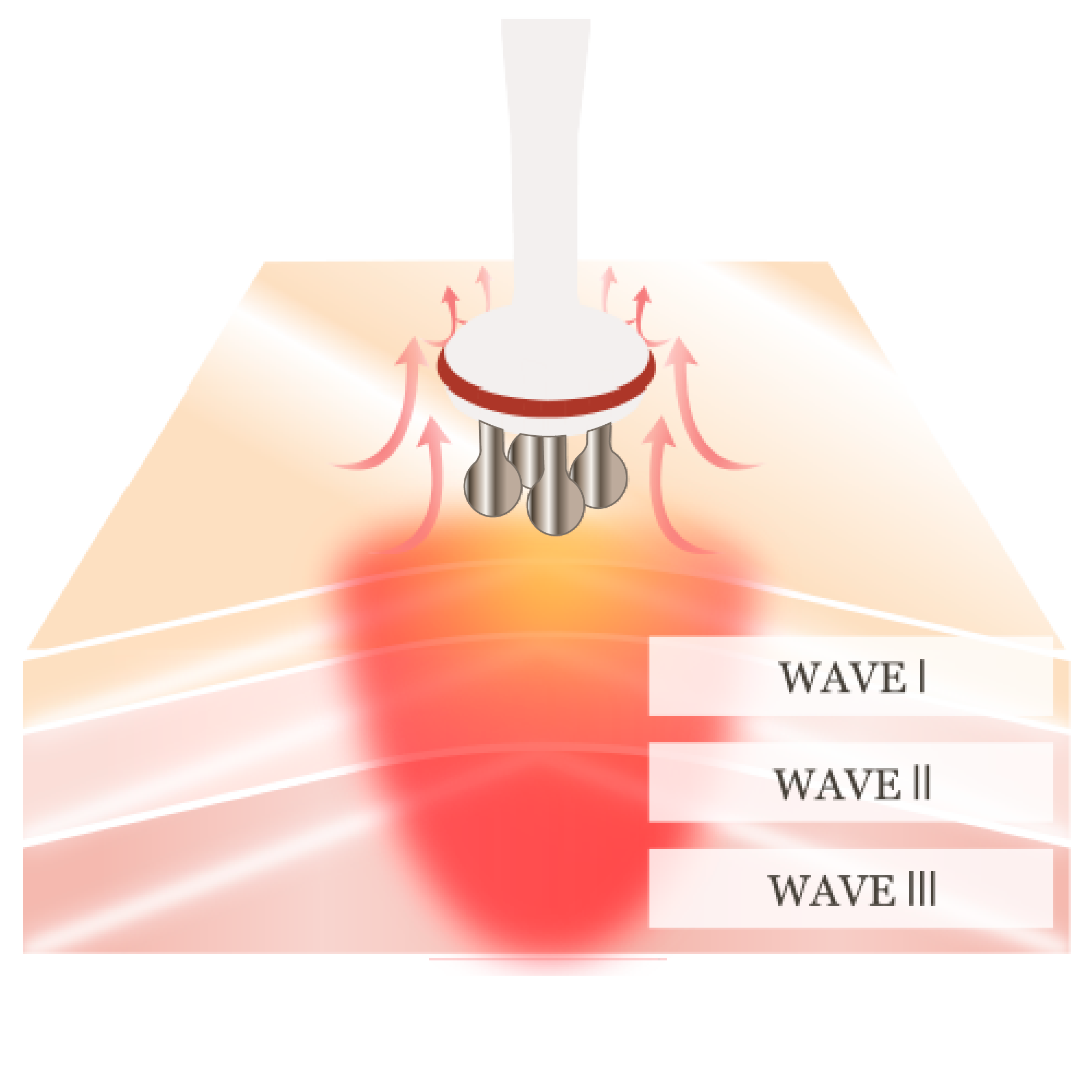 医療用干渉波の図